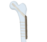 股骨端接骨板系統